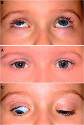 Eyelid Retraction in Isolated Unilateral Congenital Blepharoptosis